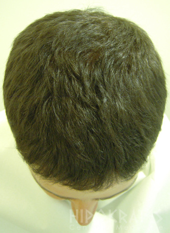 Alopecia po 1