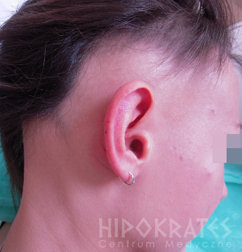 Alopecia po Ucho