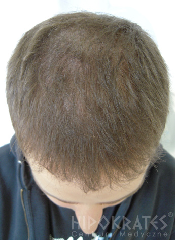 alopecia przed 1