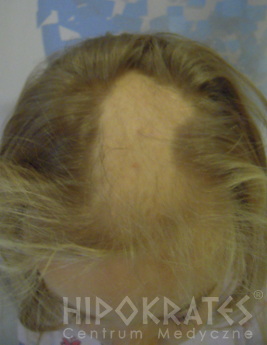 alopecia przed