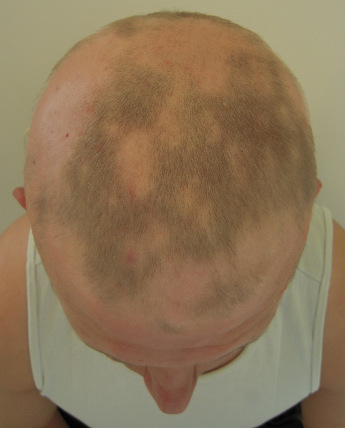 alopecia przed 23b