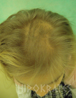 alopecia w trakcie leczenia