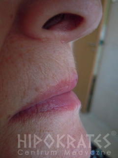 laserowe-leczenie-naczyniakow-4