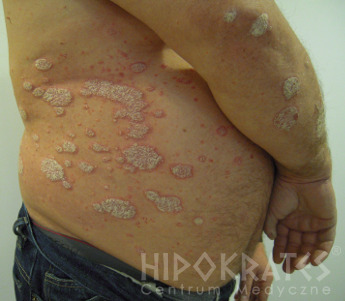 psoriasis przed 1