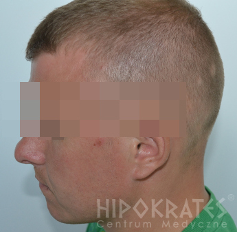 Alopecia-po-23a